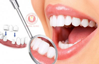 Chi phí trồng răng sứ tại Nha Khoa Sài Gòn Kim Cương ?