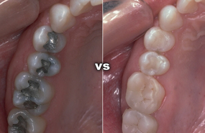 Trám răng bằng Composite và Amalgam