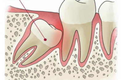 TIỂU PHẨU RĂNG KHÔN TẠI NHA KHOA SÀI GÒN KIM CƯƠNG
